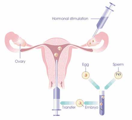 The IVF Procedure