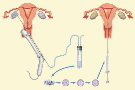 Cost Effective IVF Options
